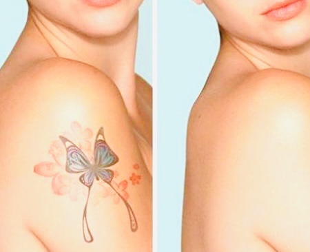 Détatouage Laser