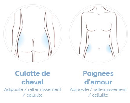 cryothérapieculotte de cheval et poignées d'amour