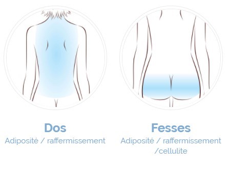 cryothérapie dos et fesses