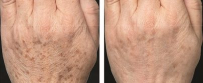Touch Skin avant/après taches sur les mains